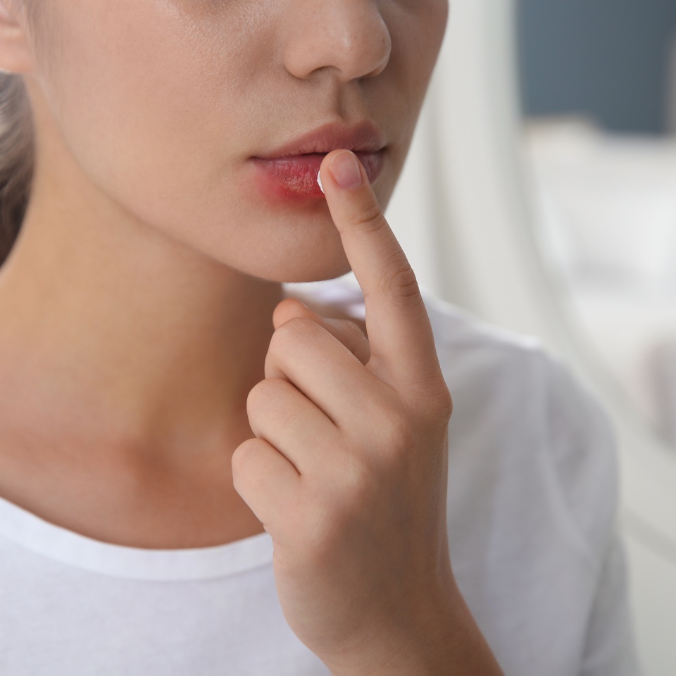 Woman with herpes applying cream on lips against blurred background, closeup