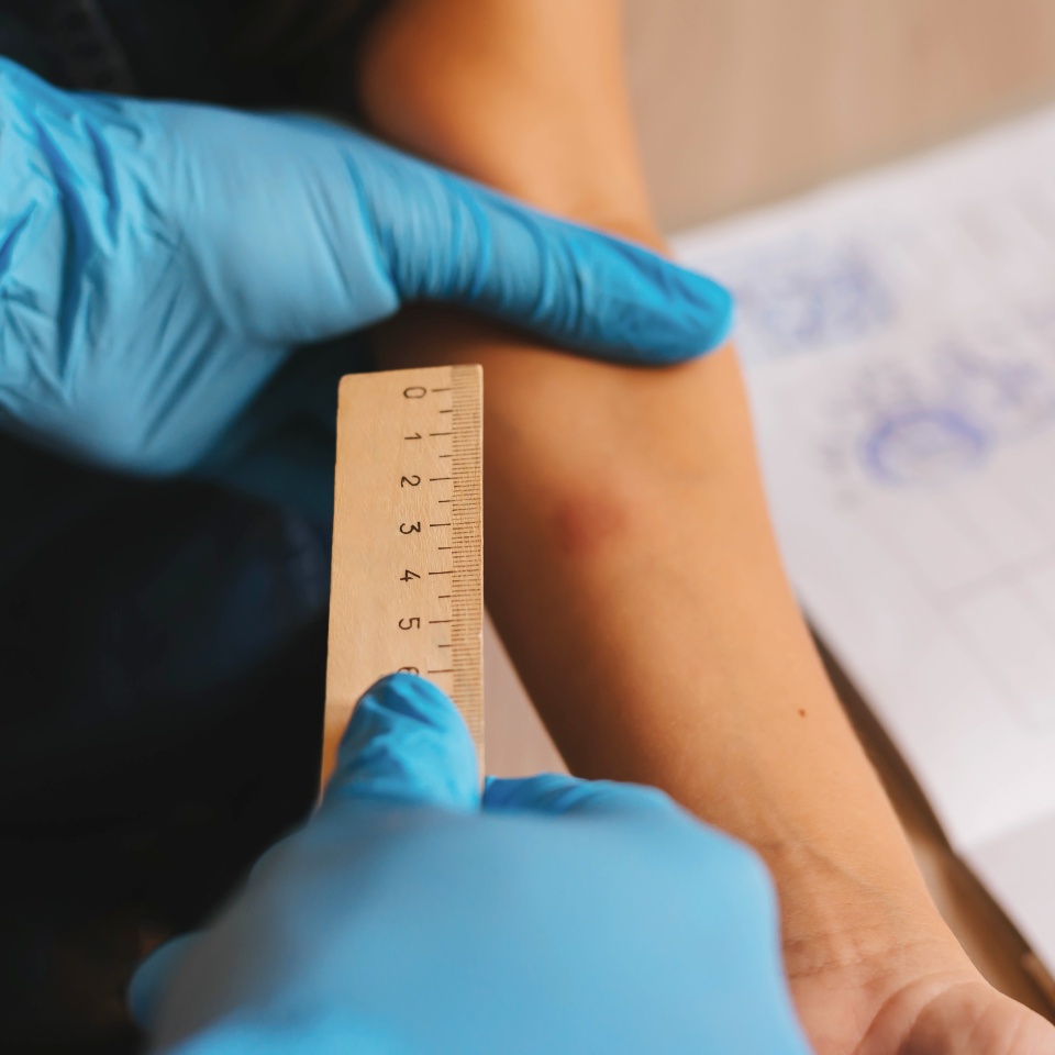 Tuberculin test on the child's arm. Analysis, inspection of the vaccination.