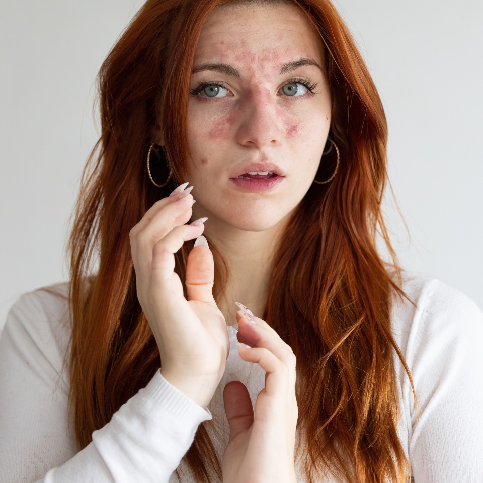 Young caucasian girl with allergic reaction due to bee sting on her face. Redness and itching on her face. Danger of anaphylactic shock