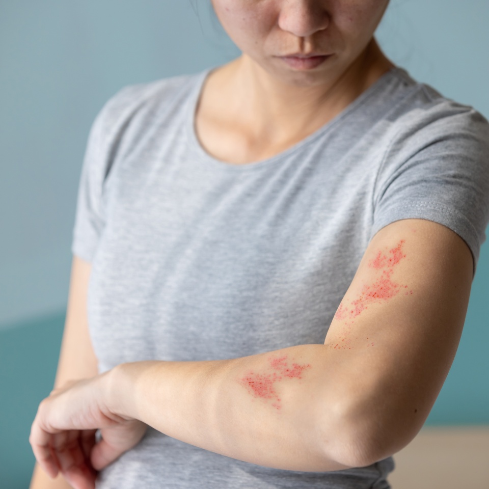 Woman with shingles on the skin she feels very painful