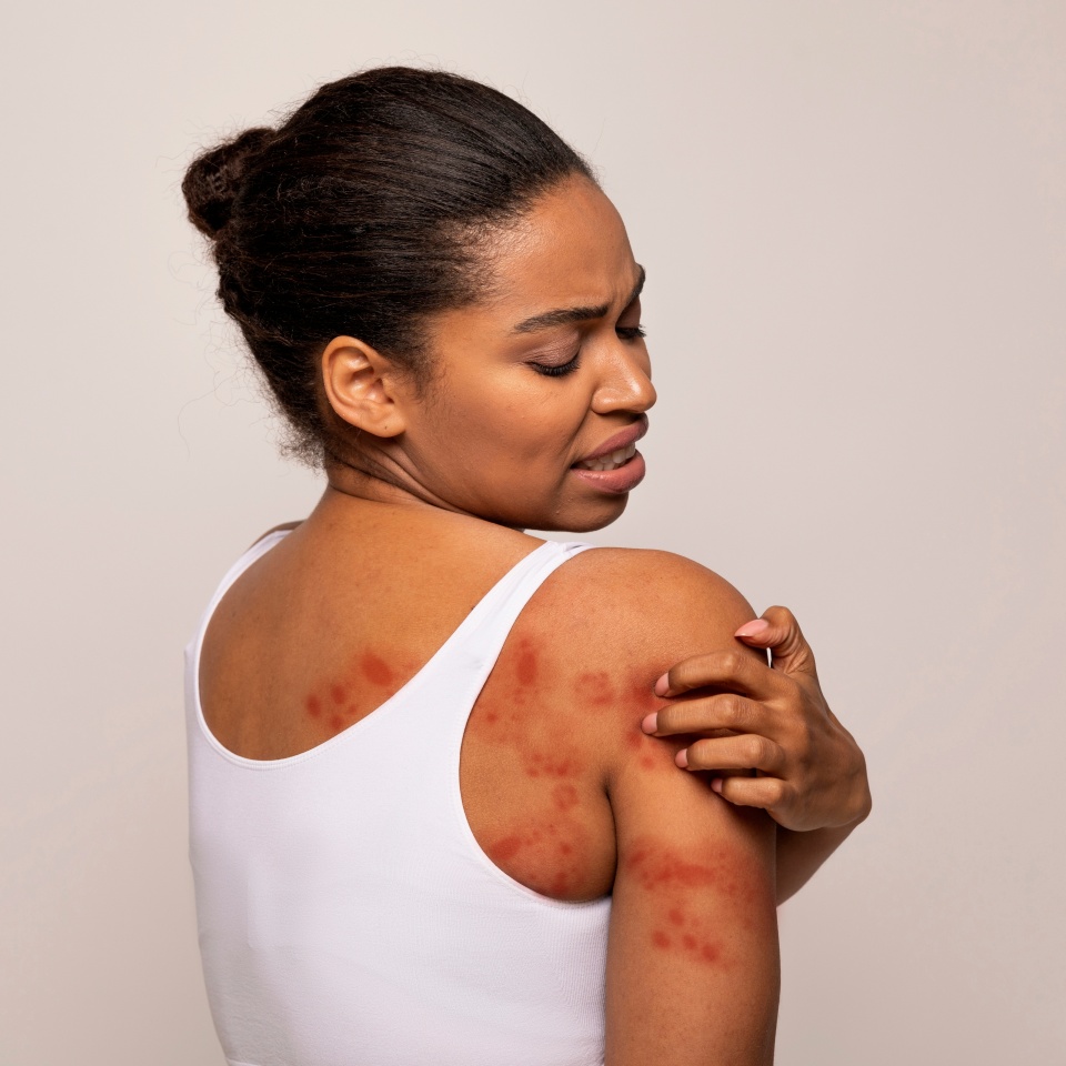 Sensitive Skin, Food allergy symptoms, Irritation. Annoyed young african american woman scratching red spots all over her body, isolated on grey studio background, copy space, back view