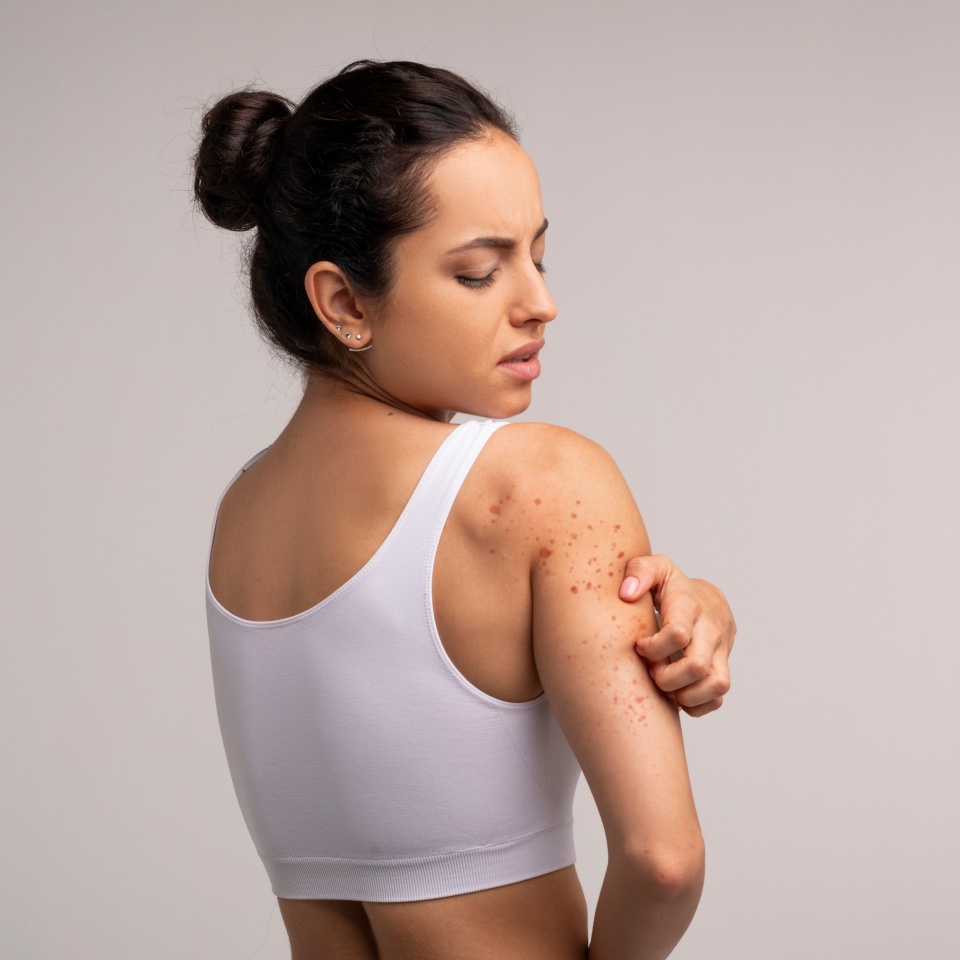 Sensitive Skin, Food allergy symptoms, Irritation. Annoyed young brunette woman scratching red spots all over her body, isolated on grey studio background, copy space, back view
