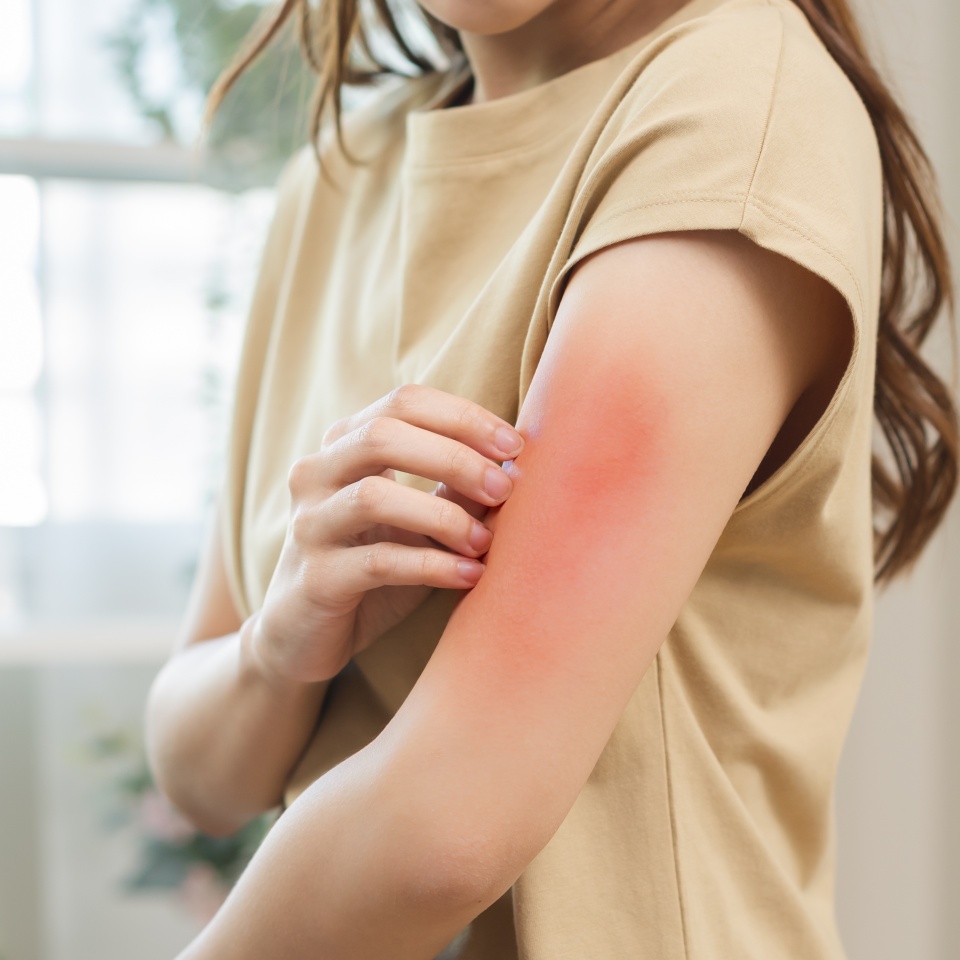 Dermatology asian young woman, girl allergy, allergic reaction from atopic, insect bites on her arm, hand in scratching itchy, itch red spot or rash of skin. Healthcare, treatment of beauty.