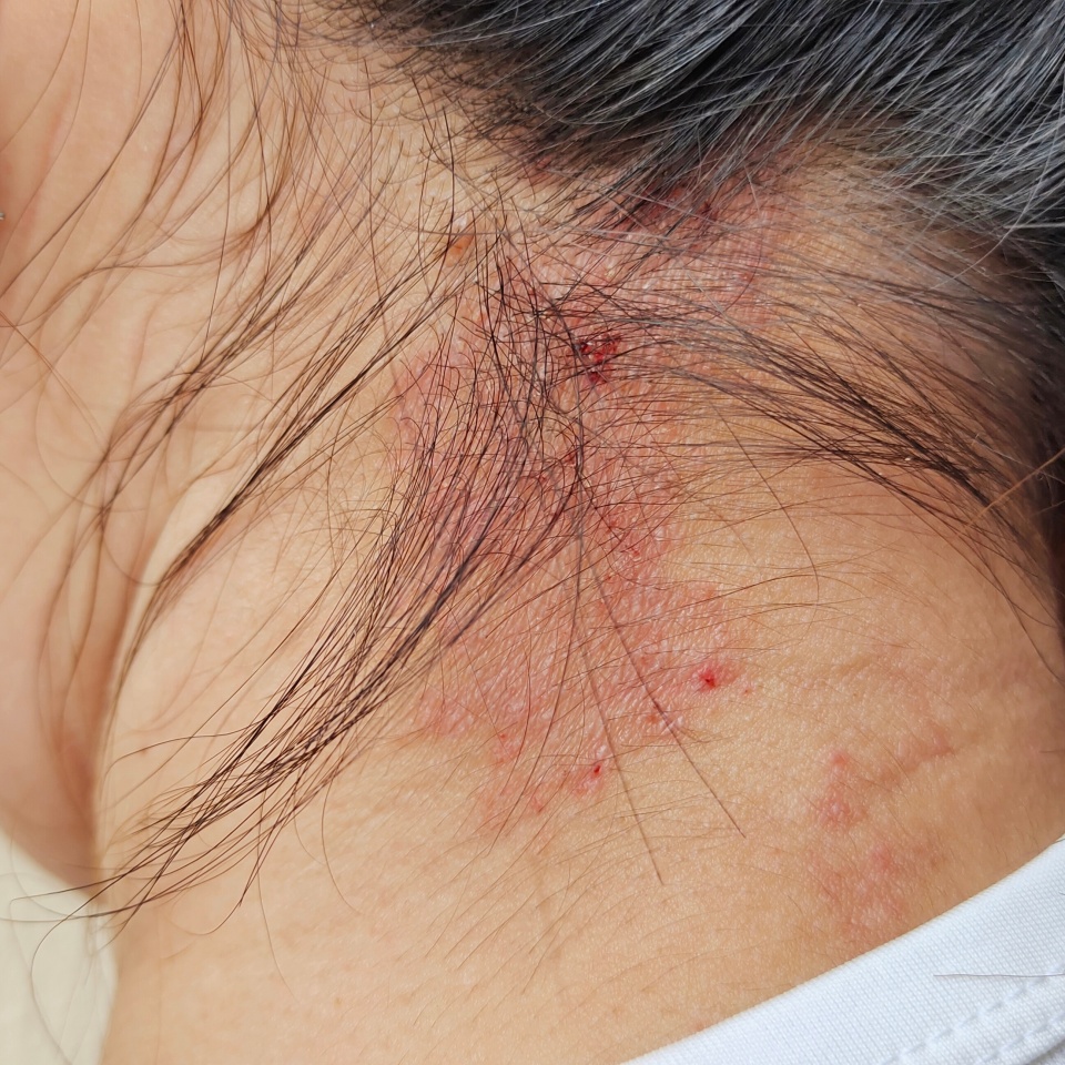 portrait the rash, hives, allergy and inflammation skin, reaction and urticaria, scar and acne, irritation and dermatitis, infection and eczema, dermatology and allergic on the neck of the woman.