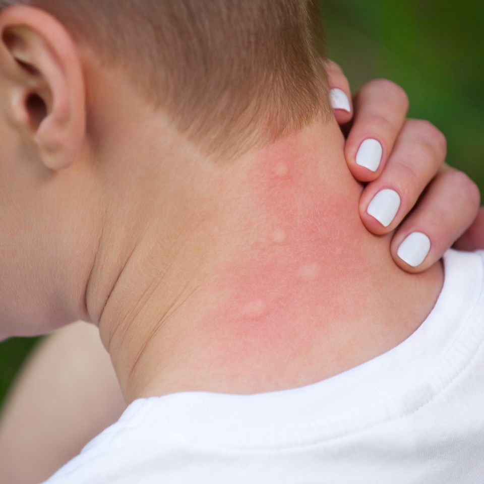 Girl with blond hair, sitting with his back turned and scratching bitten, red, swollen neck skin from mosquito bites in the summer in the forest. Close-up up of visible insect bites. Irritated skin.