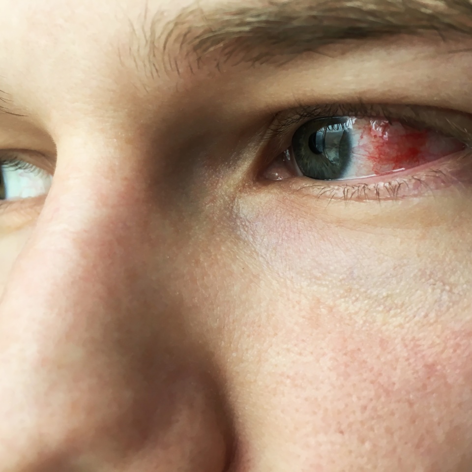 Eye disease. Red eyes. Ophthalmia