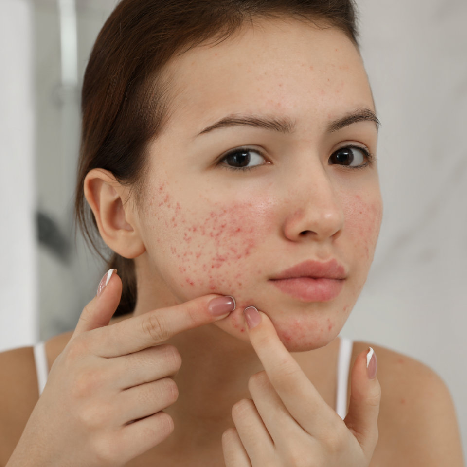 A person with acne and redness on their cheeks is gently touching their face, appearing to examine a blemish.
